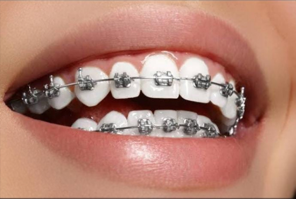 Orthodontic Treatment or Aligners