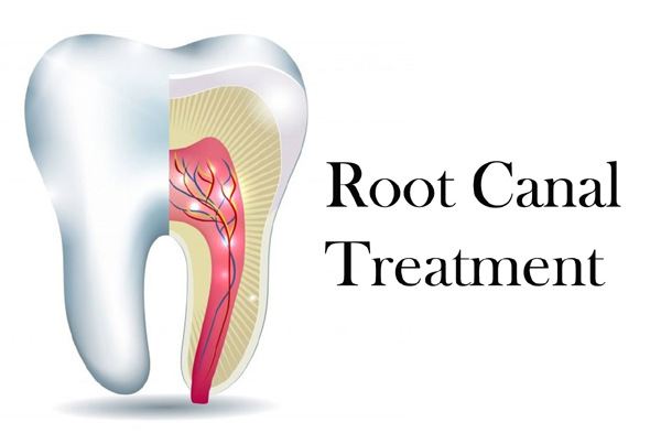 Painless Root Canal Treatment RCT