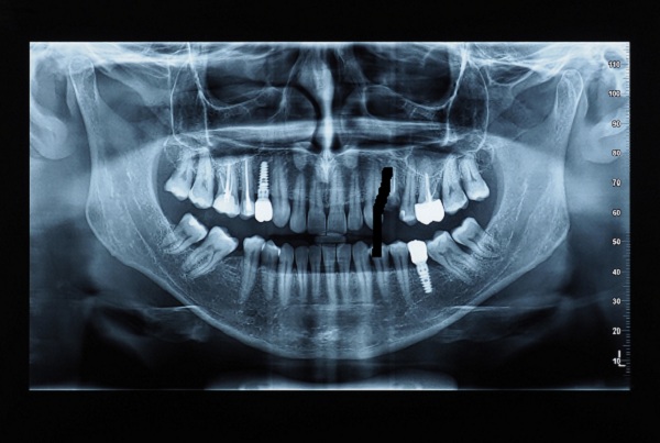 RVG Dental X Ray
