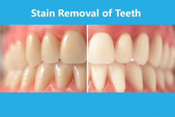 Stain Removal of Teeth