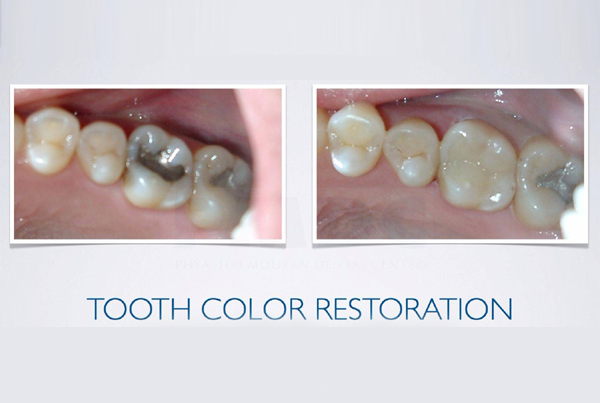 Tooth Color Restoration