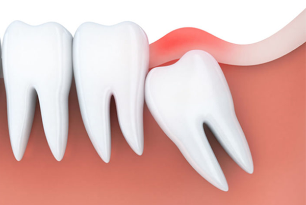Wisdom Tooth Extraction Impaction