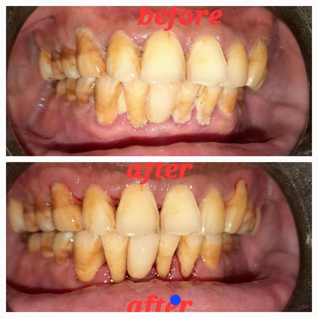 Clinic-supplied before and after gum-health case