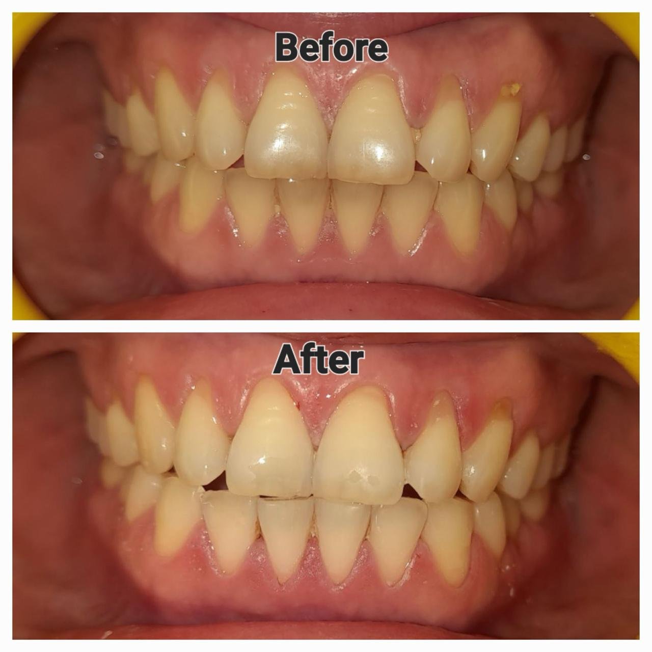 Clinic-supplied before and after dental alignment case