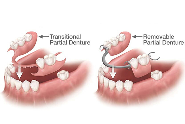 Fix Partial Denture