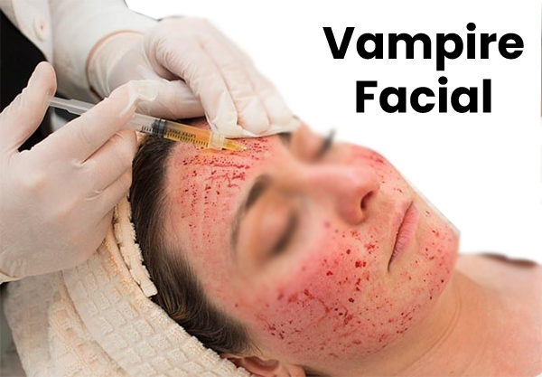 Vampire Facial
